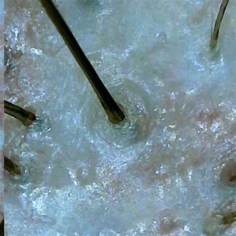 hair replacement st louis|Non.